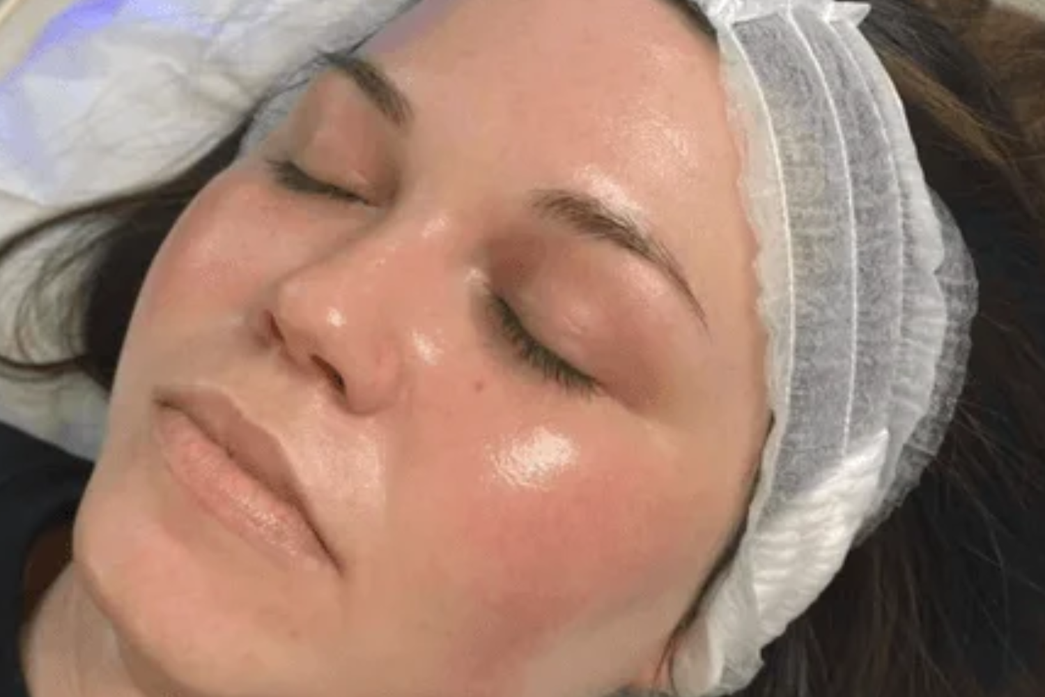 Microdermabrasion Facial Steps: Expert Guide