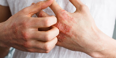 Eczema