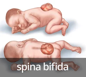 spina bifida