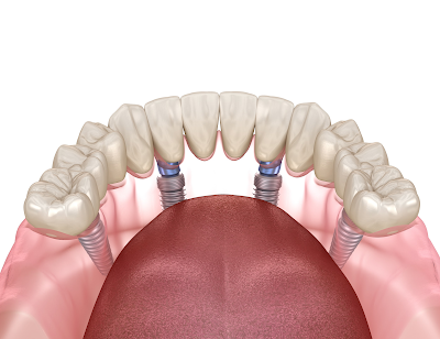 What Are All-on-4® Dental Implants Made Of