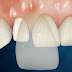 Phương pháp bọc răng sứ mất bao lâu?