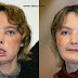 First face transplant patient Isabelle Dinoire dies in France