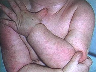 Pictures Baby Eczema on Informazioni  Settembre 2010
