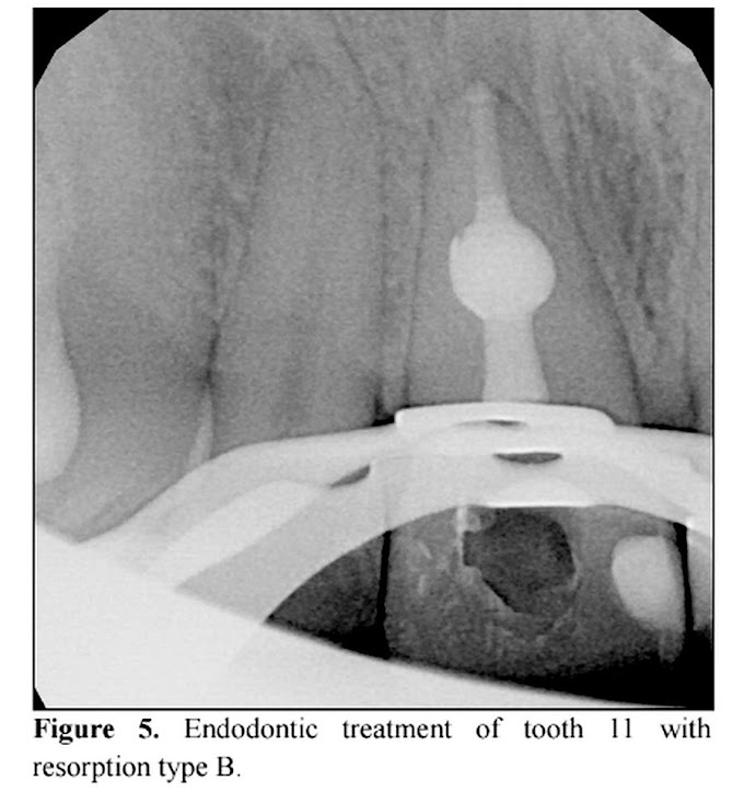 PDF: Tooth root resorption: etiopathogenesis and classification