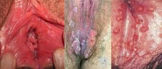 tumbuh daging dibibir vagina dalam