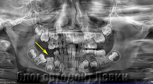 Ретинированный молочный зуб на рентген снимке