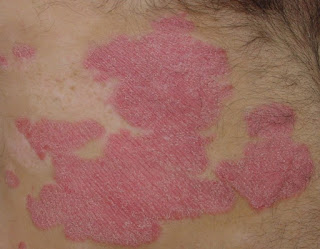 Que Es Bueno Para La Psoriasis