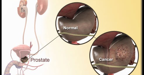 Apakah Penyebab Kanser Prostat? ~ PAWANG MODEN