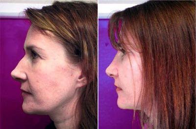 Rhinoplasty Before After