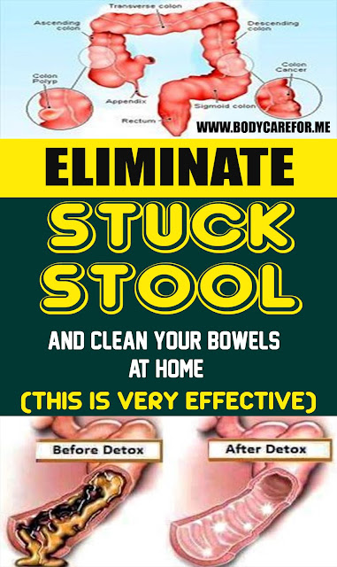 Take out Stuck Stool and Clean Your Bowels At Home!!! 