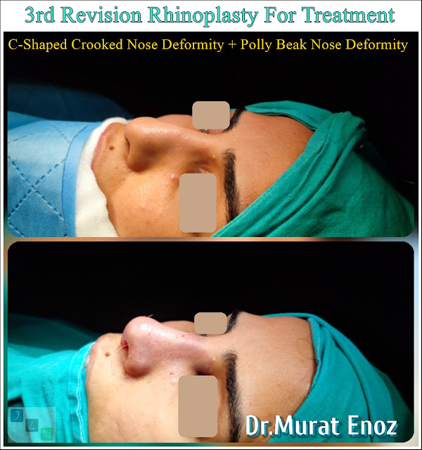 3rd Revision Rhinoplasty For Treatment of "C-Shaped Crooked Nose Deformity" + "Polly Beak Nose Deformity"