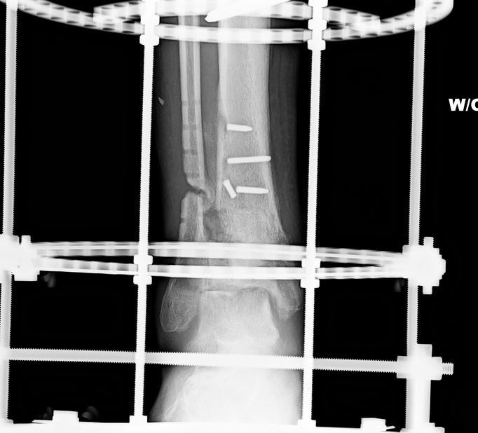 Tibial Tuberosity Avulsion Fracture. involvestibial tuberosity