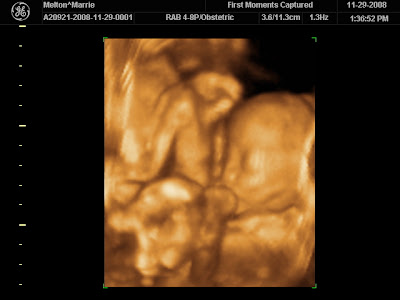 3d ultrasound pictures of twins. too 3d+sonogram+twins