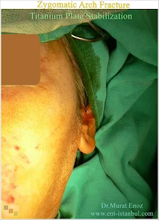 zygomatic arch anatomy, zygomatic arch fracture, titanium plate stabilization, zygomaticomaxillary complex fracture, open reduction and internal fixation, facial trauma, zygomatic fracture treatment, masseter muscle, rigid fixation, biocompatibility, comminuted fracture,