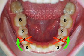 План ортодонтических перемещений для нижнего зубного ряда