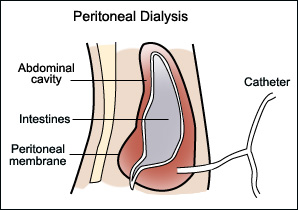 Klinik Kesihatan: Rawatan gantian ginjal dialisis peritoneum
