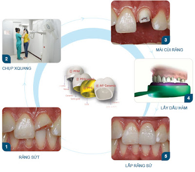 Phương pháp trồng răng sứ thẩm mỹ