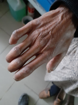 Auto amputation of fingers (hand) systemic sclerosis