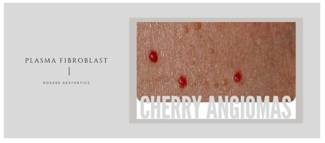 Cherry angiomas removal