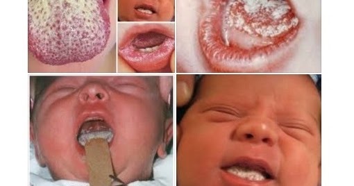 Jangkitan Kulat Pada Mulut Bayi