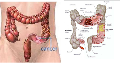 Gejala Kanker Usus Yang Wajib Tahu