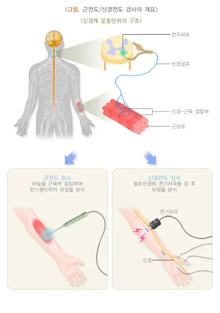 근전도-신경전도-검사-개요