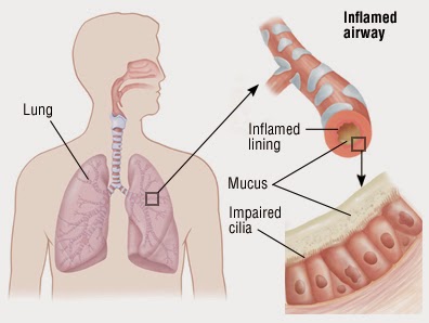 What are the Symptoms of Bronchitis