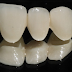 Quy trình bọc răng sứ hàm dưới