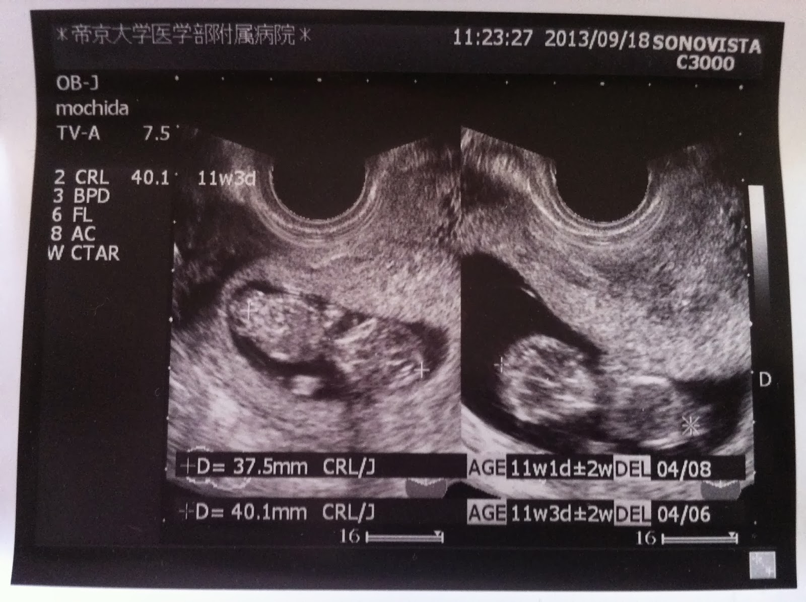 Niblog 双子妊娠11週目のエコー画像 11w3d 検診 Vol 6