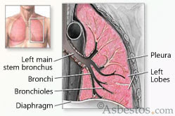 Mesothelioma