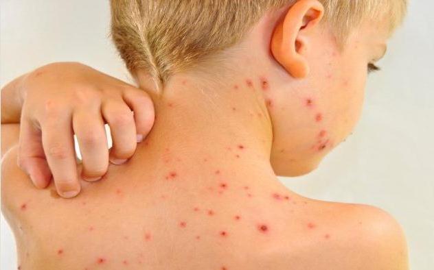 Home Remedies Chickenpox Disease and Facts