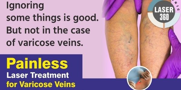 Laser Treatment For Varicose Veins