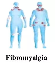 Fibromyalgia