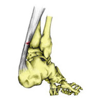 pemeriksaan Fisioterapi RUPTUR TENDO ACHILLES