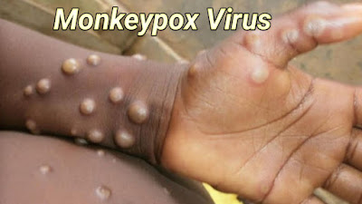 Monkeypox : मंकीपॉक्स