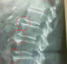 Radiografia de espondilosis deformante