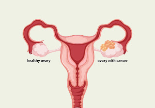 Warning Signs of Ovarian Cancer the Silent Killer