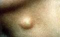 Sebaceous Cyst (Cyst Keratinous) causes symptoms diagnosis