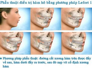 Phương pháp điều chỉnh răng hô hàm trên nên biết