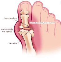 Tips Kesehatan Bagi Penderita Asam Urat
