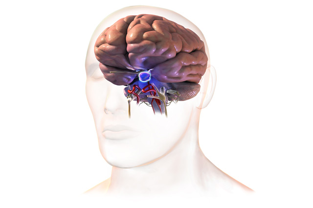 pituitary tumor surgery