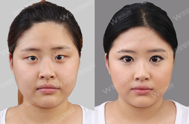 짱이뻐! - Before and After Photos Korean Eye Plastic Surgery