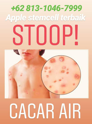 Apakah anda sedang mencari info obat Herbal cacar air alami paling ampuh, dan obat tradisional cacar air agar cepat kering, cara supaya cacar air cepat sembuh, atasi cacar air dewasa.