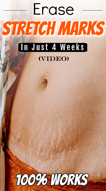 Stretch Marks Can Be Removed Quickly & Easily In Just 4 Weeks - Guaranteed! (Video)