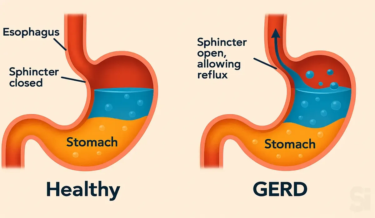 Gastroesophageal-Reflux-Disease
