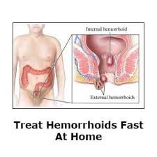 How to Get Rid of Hemorrhoids Quickly