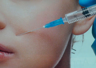 botox injection