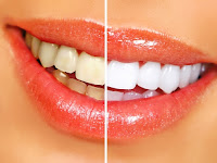 Encinitas Teeth Whitening