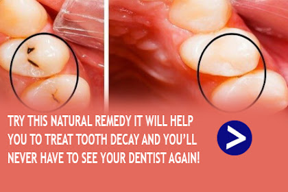TRY THIS NATURAL REMEDY IT WILL HELP YOU TO TREAT TOOTH DECAY AND YOU’LL NEVER HAVE TO SEE YOUR DENTIST AGAIN!