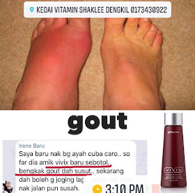 Vivix Untuk Gout